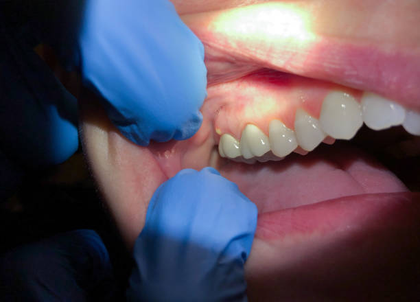 Best Tooth Infection Emergency Dentist  in Bean Station, TN