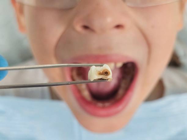Best Root Canal Emergency Dentist  in Bean Station, TN